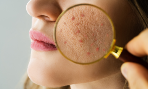 Medical Acne Treatment