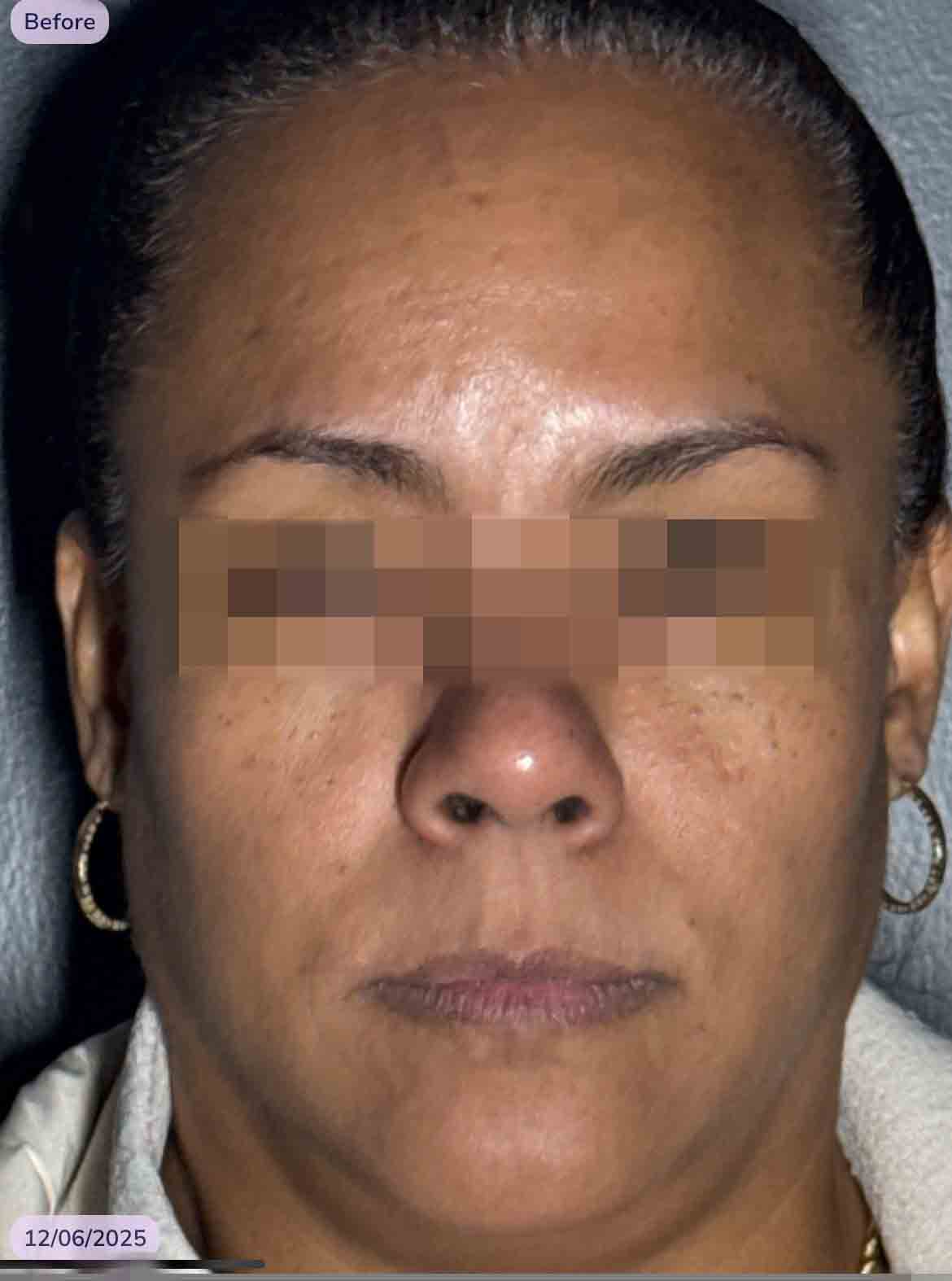 Deep Glabella, 11 frown lines