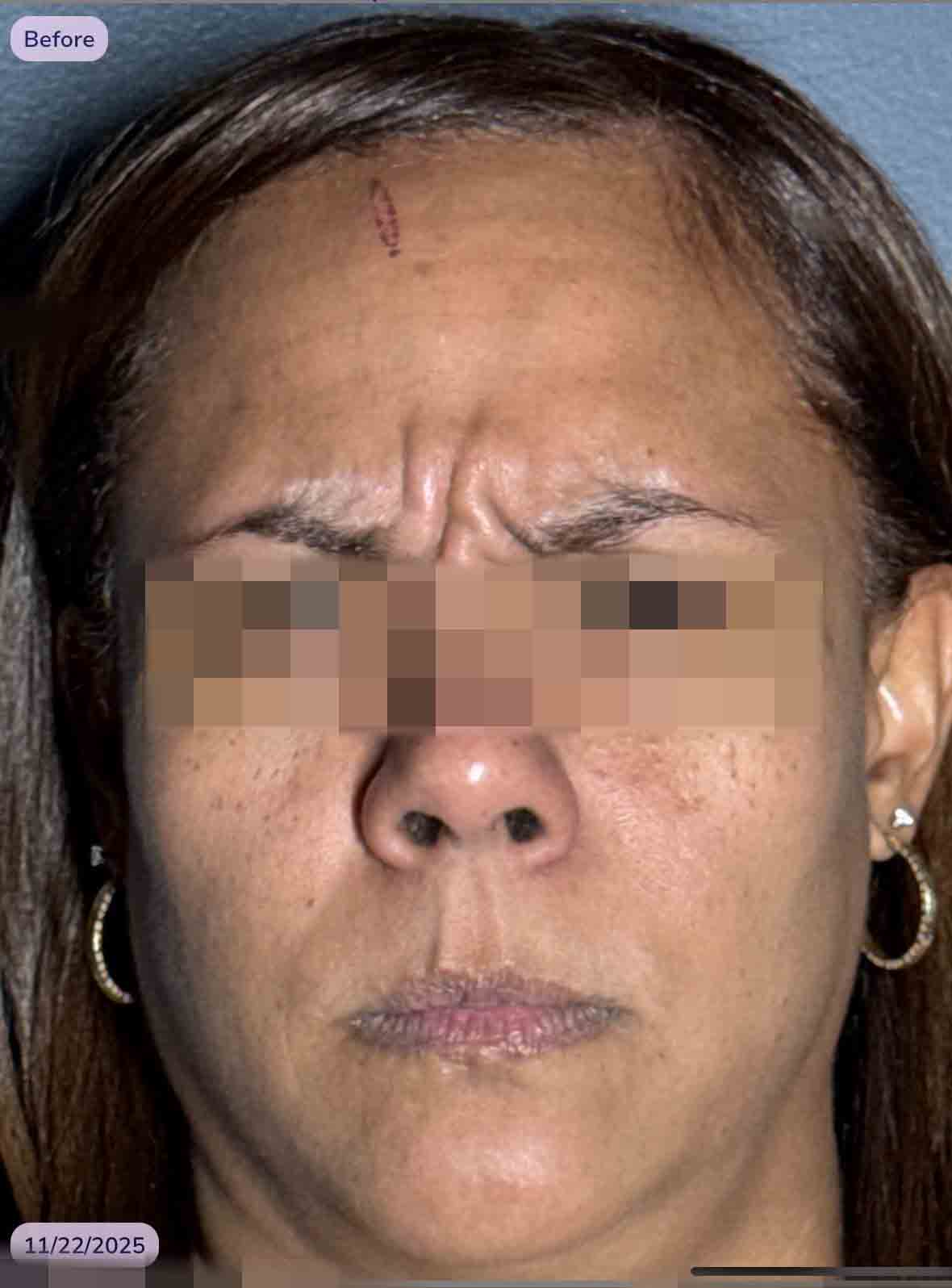 Deep Glabella, 11 frown lines
