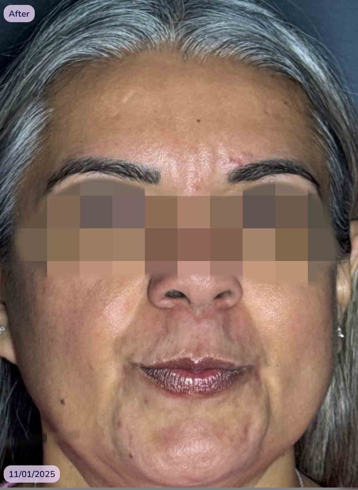 Del Glabella