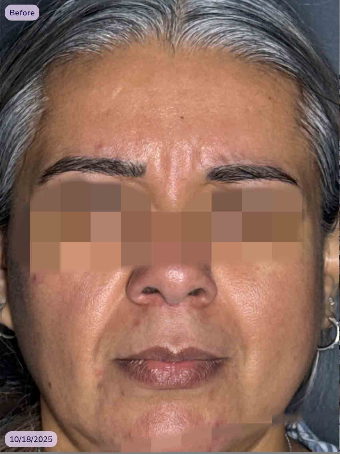 Del Glabella