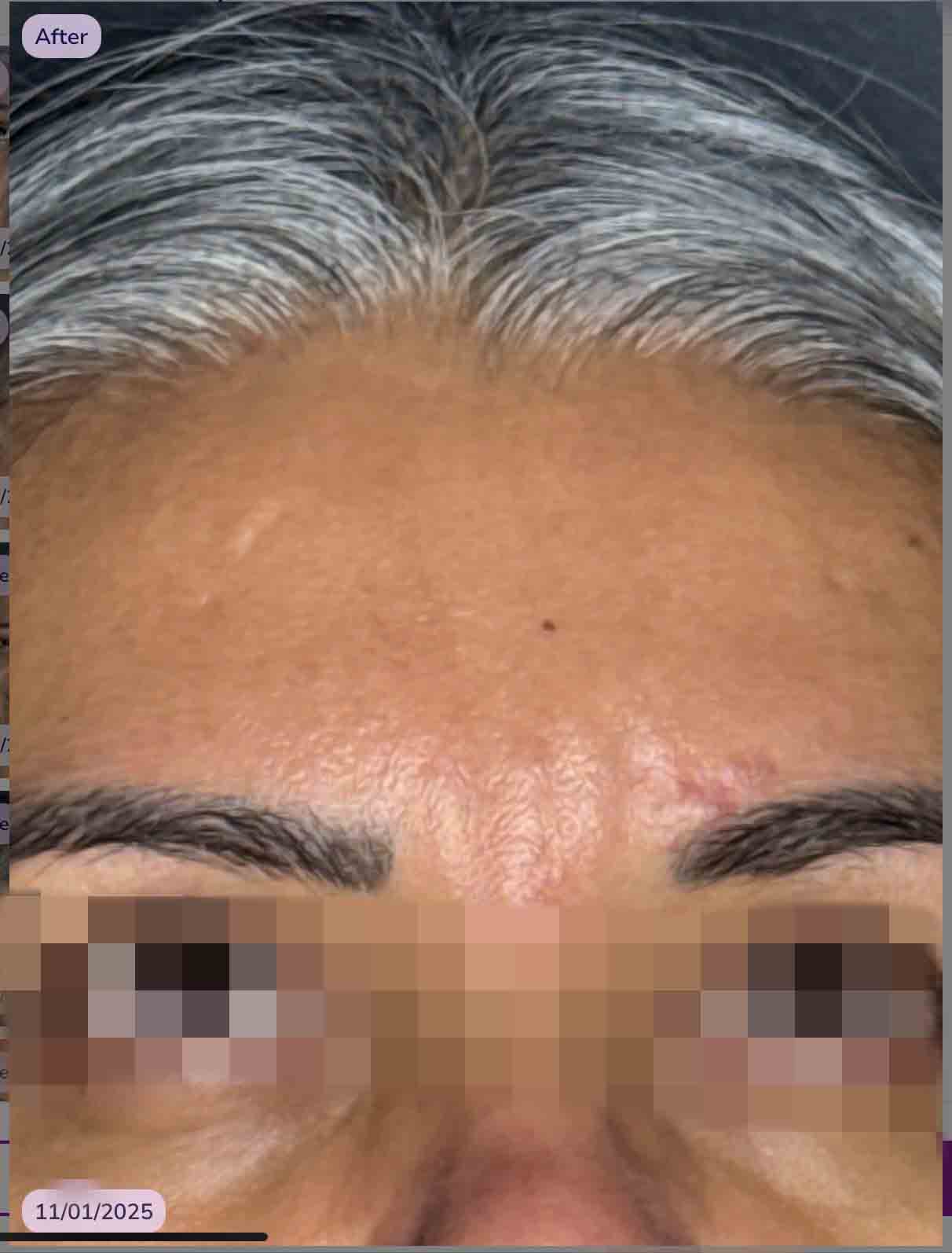 Glabella 11