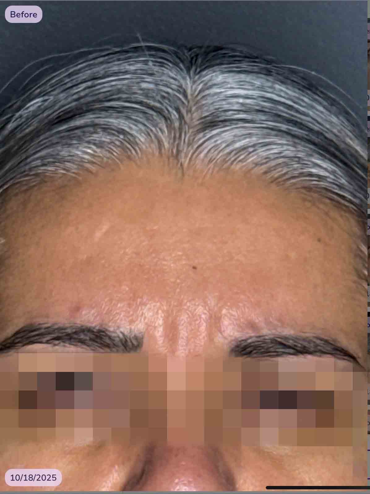 Glabella 11