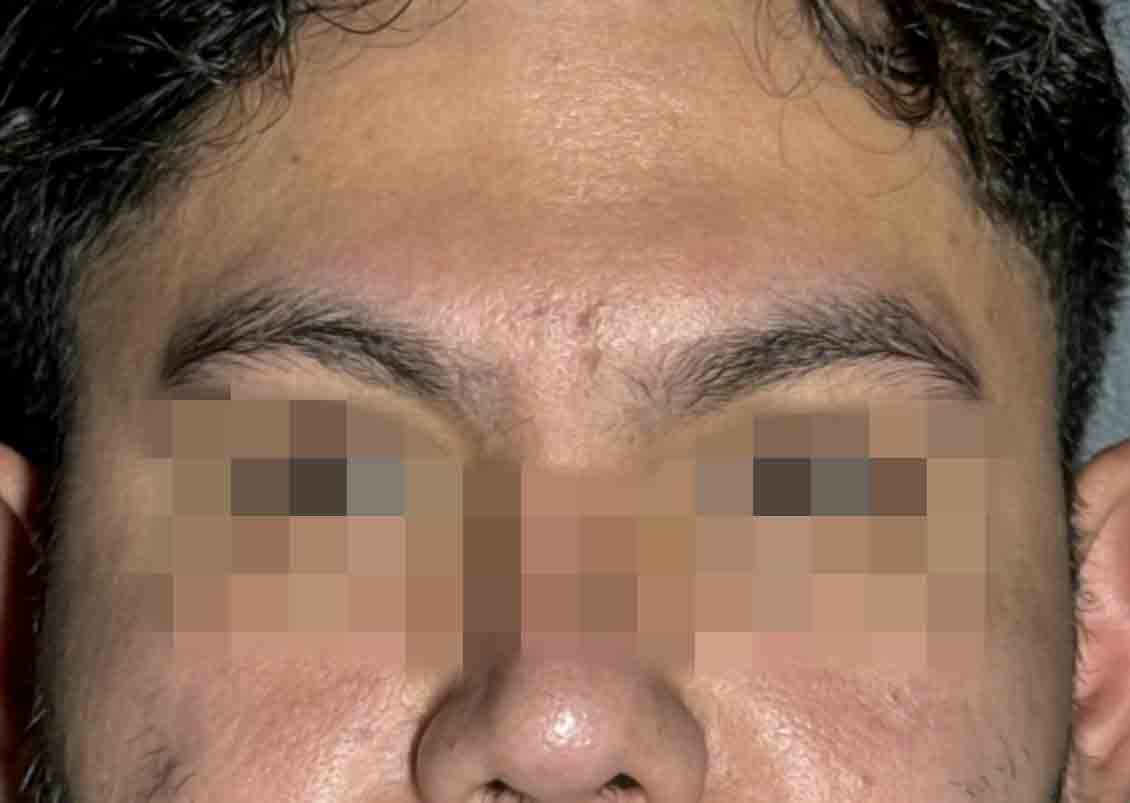 Glabella 11 lines pdo