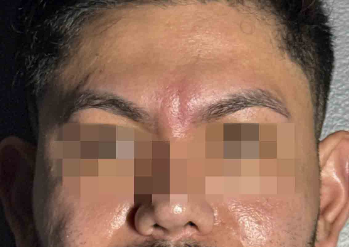 Glabella 11 lines pdo
