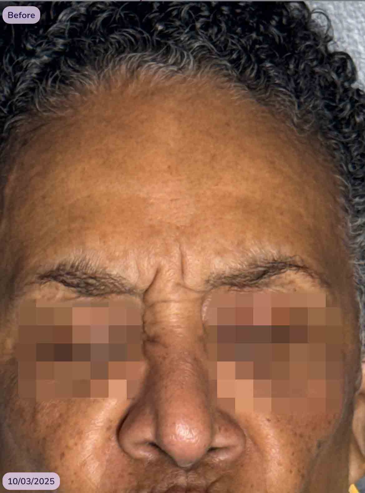 Glabella TOX