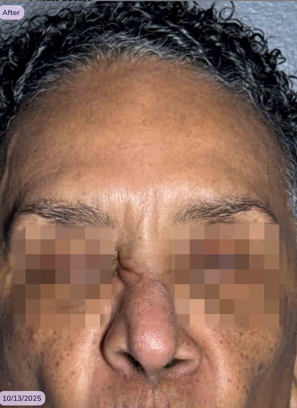 Glabella TOX