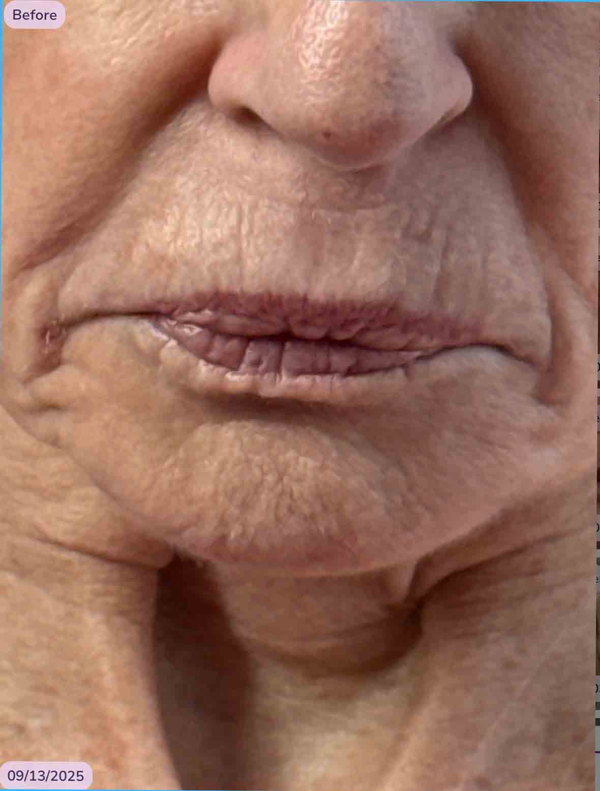 KB lips and smokers line filler