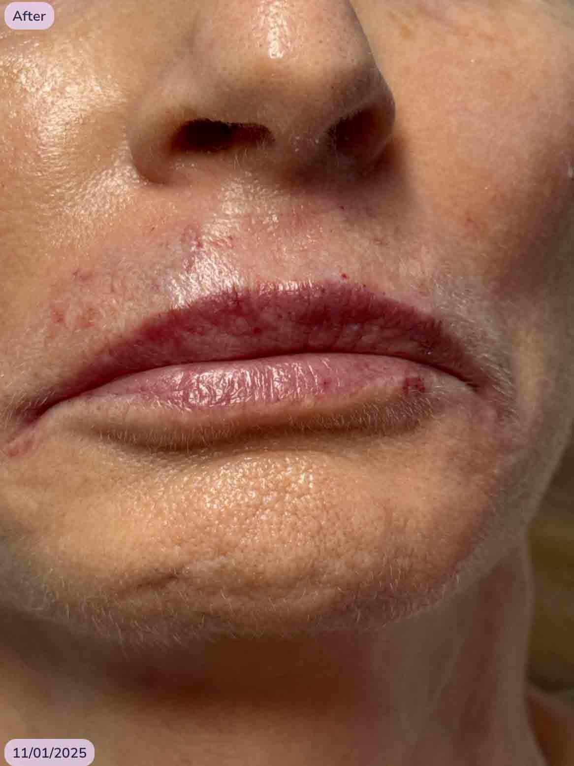 KB lips and smokers line filler