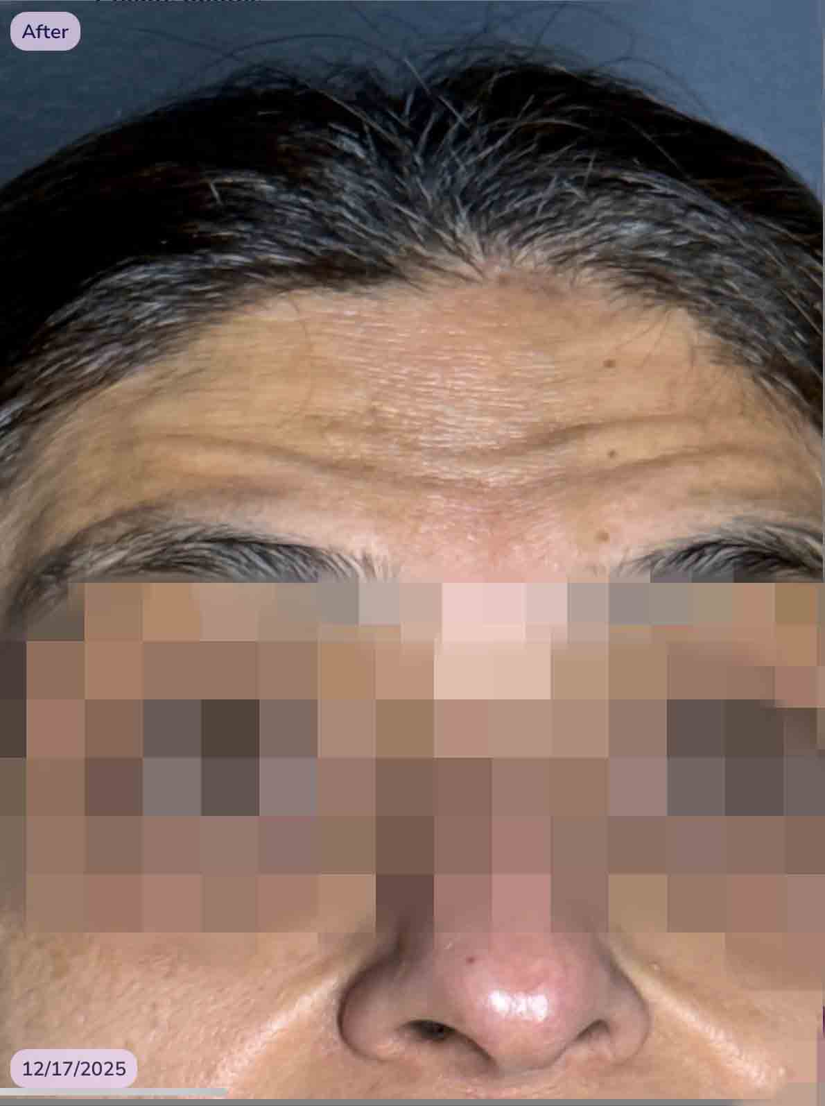 TOX after 4 months