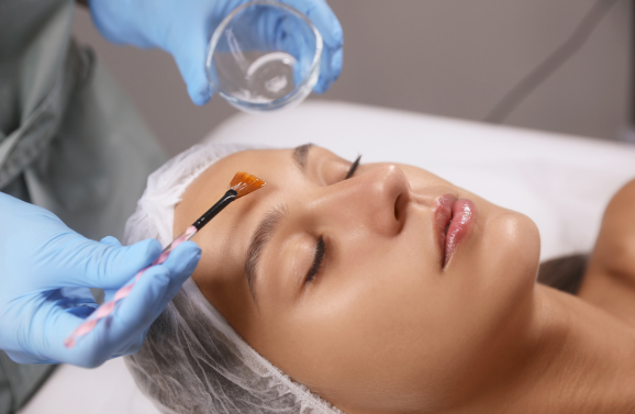 Chemical Peels Houston tx